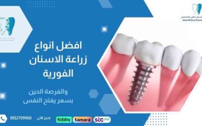 أفضل أنواع زراعة الأسنان الفورية في السعودية