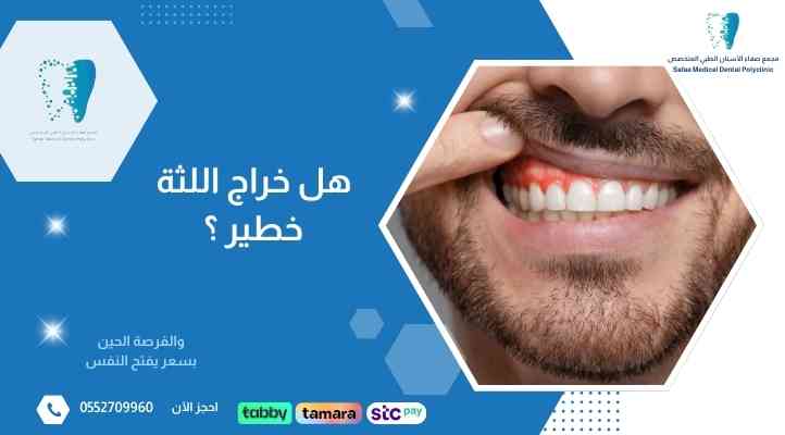 هل-خراج-اللثة-خطير هل-خراج-اللثة-خطير
