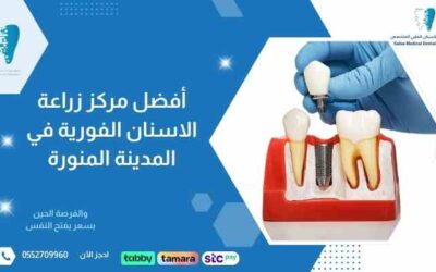 أفضل مركز زراعة الاسنان الفورية في المدينة المنورة