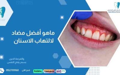 ما هو أفضل مضاد لالتهاب الاسنان