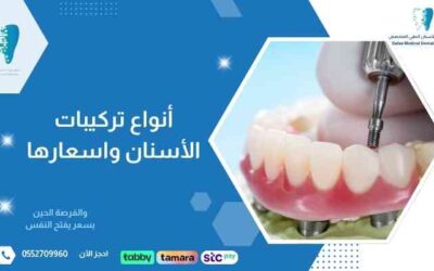أنواع تركيبات الأسنان واسعارها