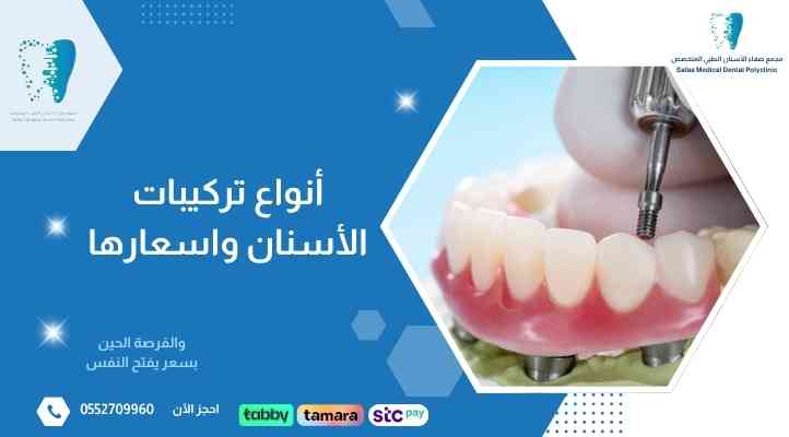 أنواع تركيبات الأسنان واسعارها