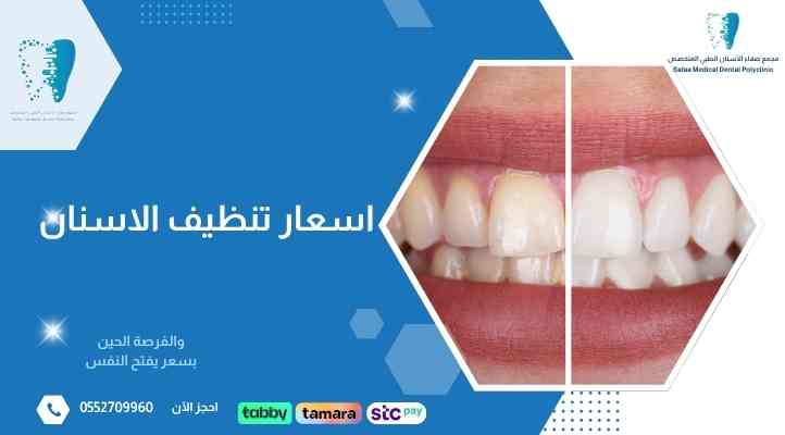 اسعار-تنظيف-الاسنان