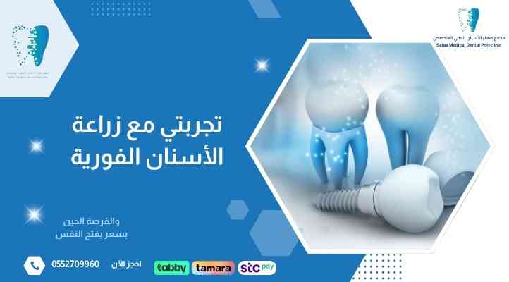 تجربتي مع زراعة الأسنان الفورية