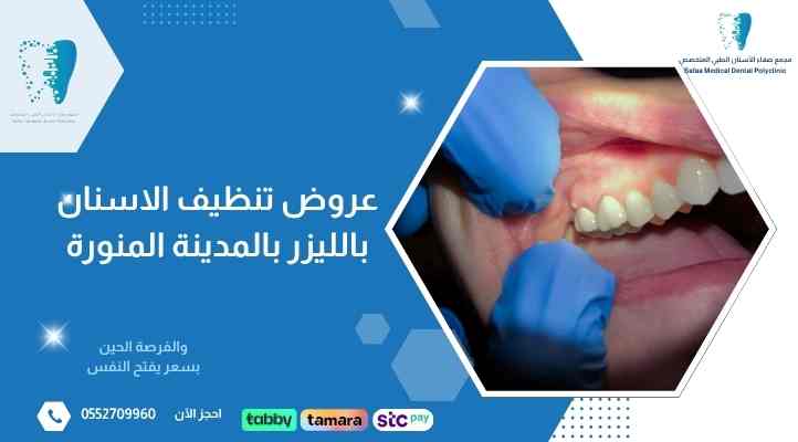 عروض تنظيف الاسنان بالليزر بالمدينة المنورة